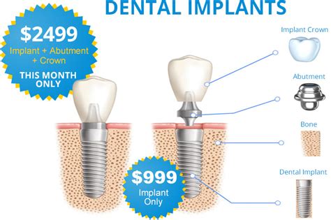 cheapest single dental implants in the atlanta ga area